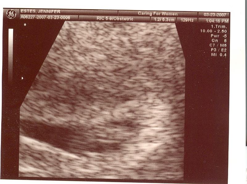 Ultrasound 03/23/2007