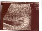 Ultrasound 03/23/2007