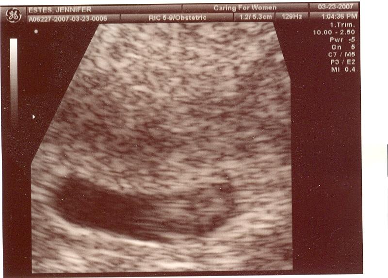 Ultrasound 03/23/2007