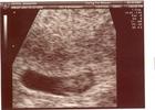 Ultrasound 03/23/2007